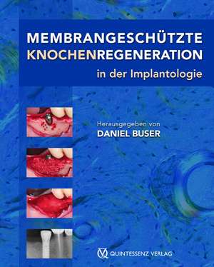 Membrangeschütze Knochenregeneration in der Implantologie de Th. von Arx