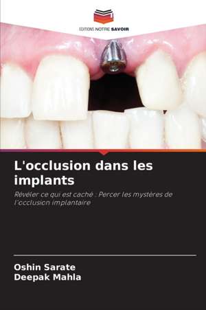 L'occlusion dans les implants de Oshin Sarate