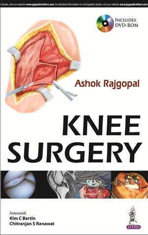 Knee Surgery de Ashok Rajgopal