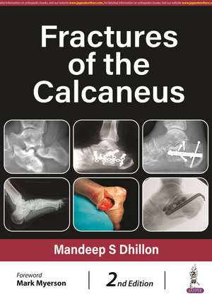 Fractures of the Calcaneus de Mandeep S Dhillon