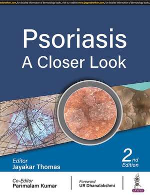 Psoriasis: A Closer Look de Jayakar Thomas