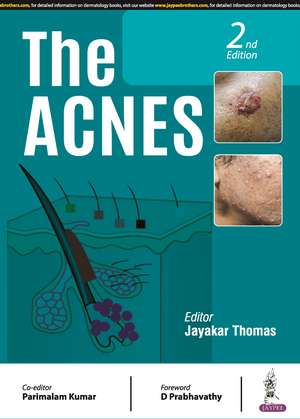 The Acnes de Jayakar Thomas