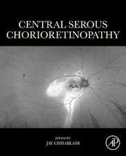 Central Serous Chorioretinopathy