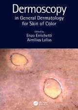 Dermoscopy in General Dermatology for Skin of Color