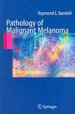 Pathology of Malignant Melanoma