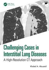 Challenging Cases in Interstitial Lung Diseases