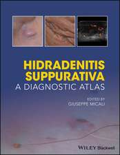 Hidradenitis Suppurativa – A Diagnostic Atlas