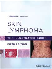 Skin Lymphoma – The Illustrated Guide