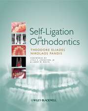 Self–Ligation in Orthodontics