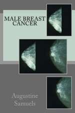 Male Breast Cancer