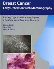 Casting Type Calcifications: Sign of a Subtype with Deceptive Features