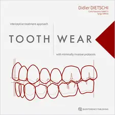 Tooth Wear