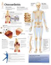 Understanding Osteoarthritis Chart: Laminated Wall Chart