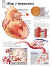 Effects of Hypertension Chart: Laminated Wall Chart