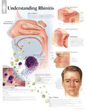 Understanding Rhinitis Chart: Wall Chart