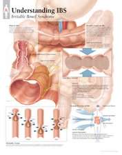 Understanding Ibs Chart: Wall Chart