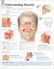 Understanding Sinusitis Chart: Wall Chart