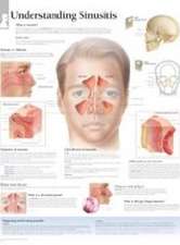 Understanding Sinusitis Paper Poster