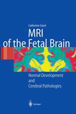 MRI of the Fetal Brain: Normal Development and Cerebral Pathologies