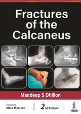 Fractures of the Calcaneus